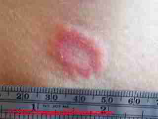 Mold skin rash found on exposure to high levels of Stachybotrys chartarum (C) D Friedman