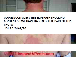 Skin rash associated with mold sensitivity © D Friedman at InspectApedia.com 